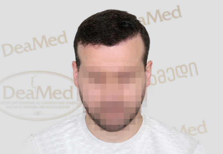 Deamed - hair transplantation results / თმის გადანერგვის შედეგები