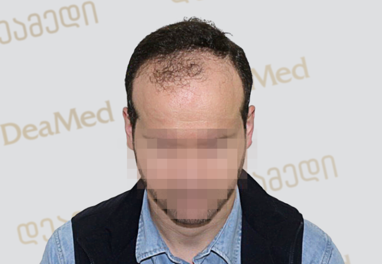 Deamed - hair transplantation results / თმის გადანერგვის შედეგები