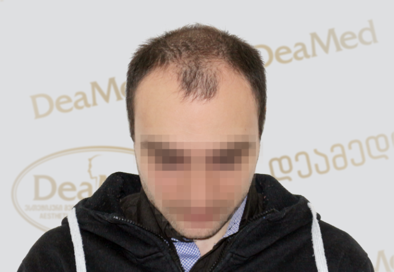 Deamed tmis gadanergva shedegebi