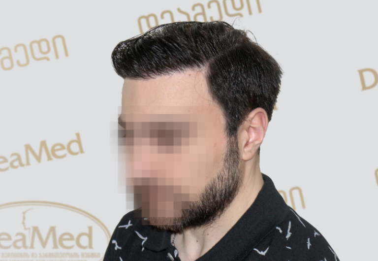 Deamed tmis gadanergva shedegebi