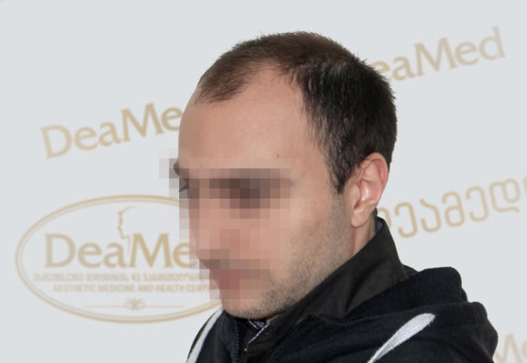 Deamed tmis gadanergva shedegebi