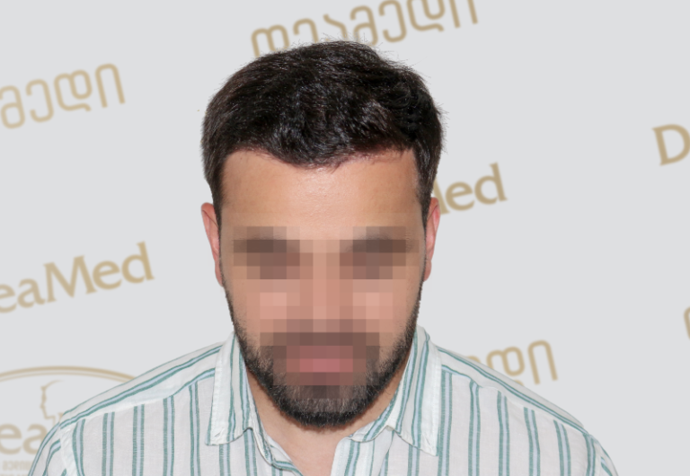 Deamed tmis gadanergva shedegebi