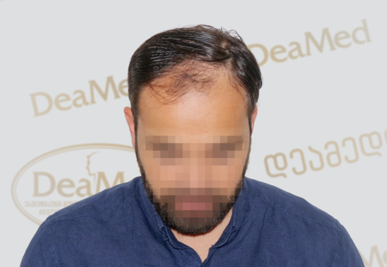 tmis gadanergva shedegebi