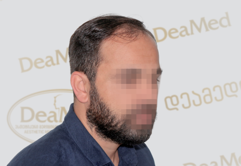 Deamed tmis gadanergva shedegebi