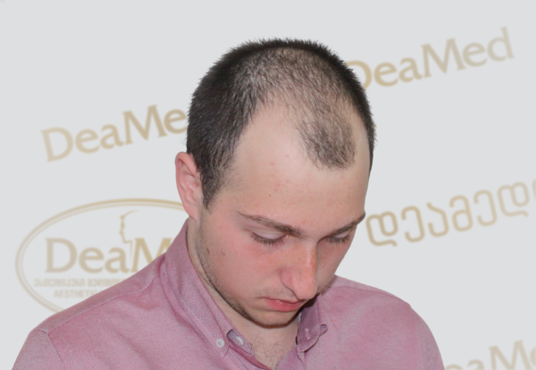 tmis gadanergva shedegebi