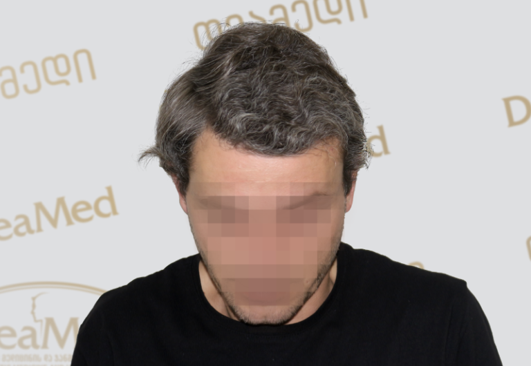 Deamed tmis gadanergva shedegebi