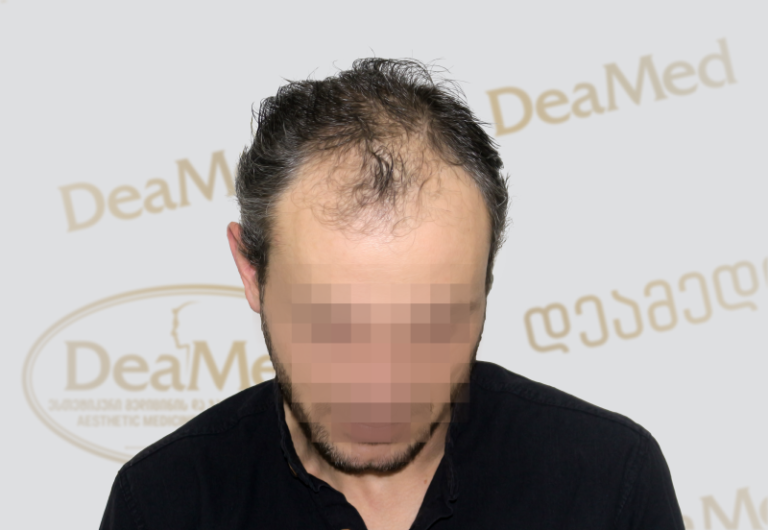 Deamed tmis gadanergva shedegebi