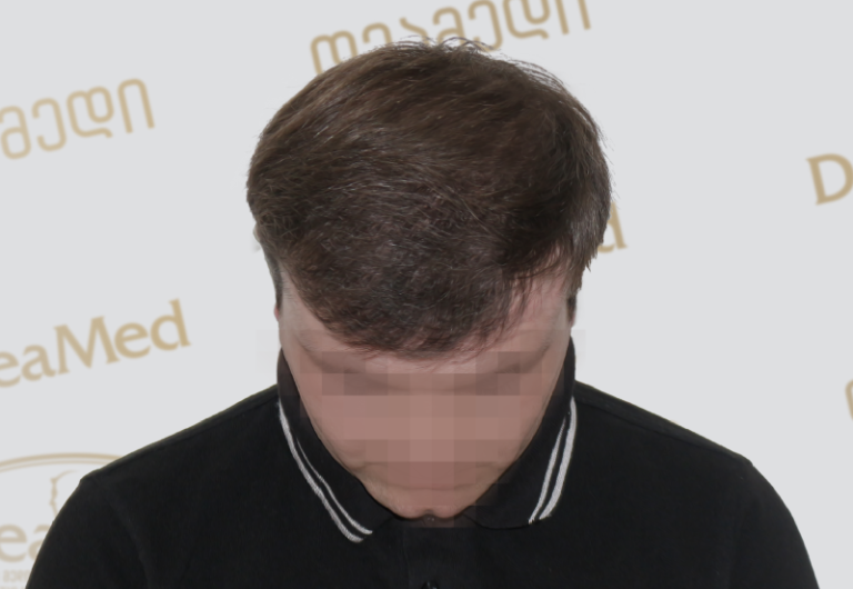 Deamed tmis gadanergva shedegebi