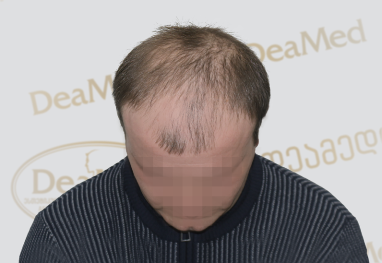 Deamed tmis gadanergva shedegebi