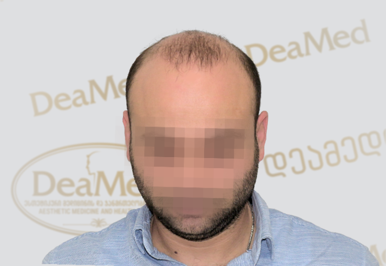 Deamed tmis gadanergva shedegebi