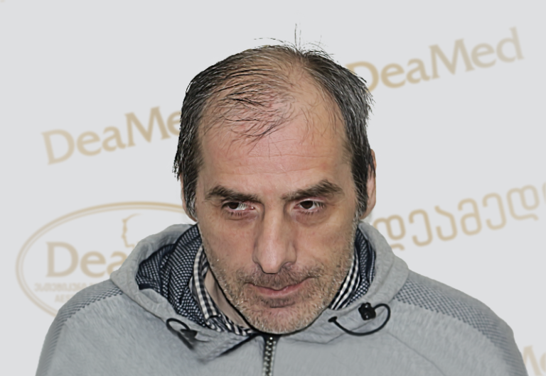 Deamed tmis gadanergva shedegebi