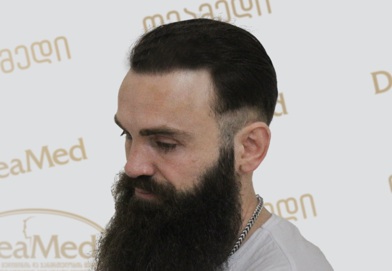 Deamed tmis gadanergva shedegebi