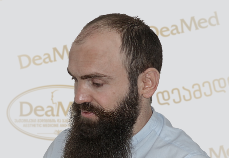 Deamed tmis gadanergva shedegebi