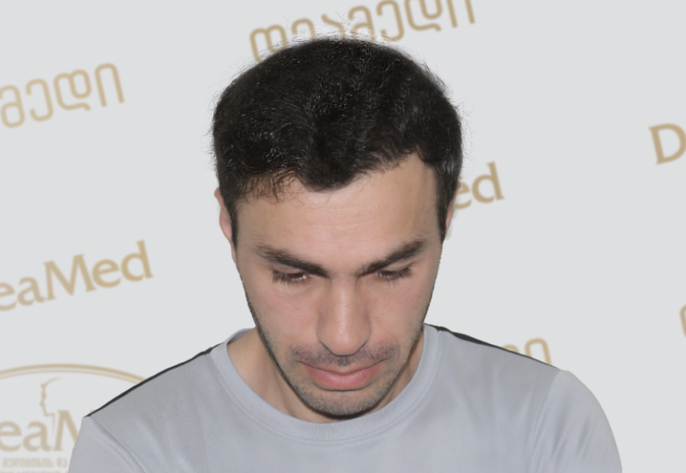 Deamed tmis gadanergva shedegebi