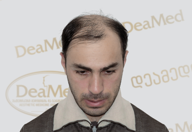 Deamed tmis gadanergva shedegebi