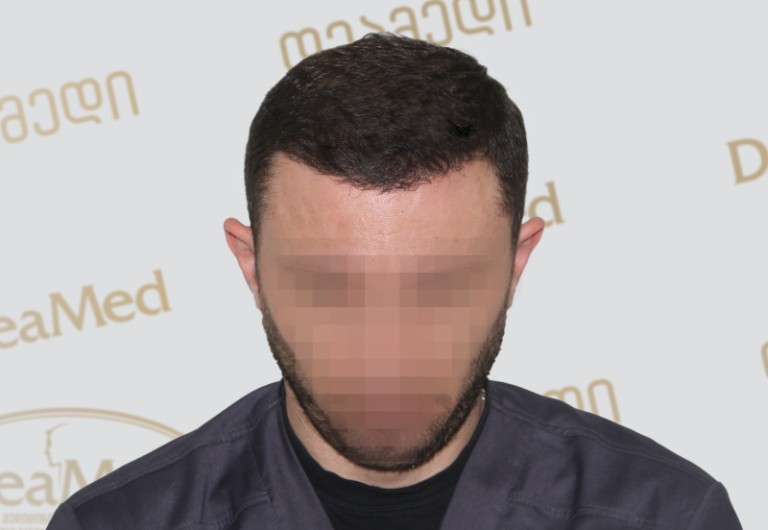 Deamed tmis gadanergva shedegebi