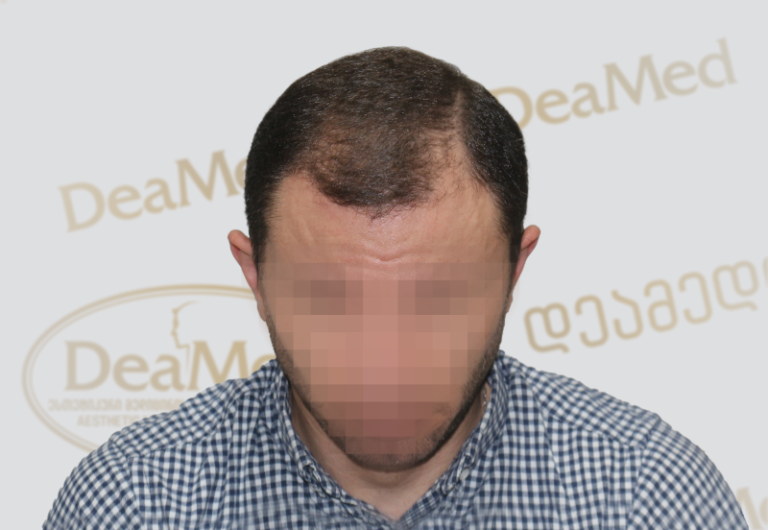 Deamed tmis gadanergva shedegebi