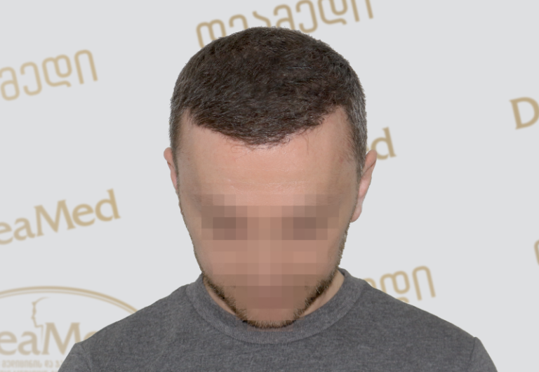 Deamed tmis gadanergva shedegebi