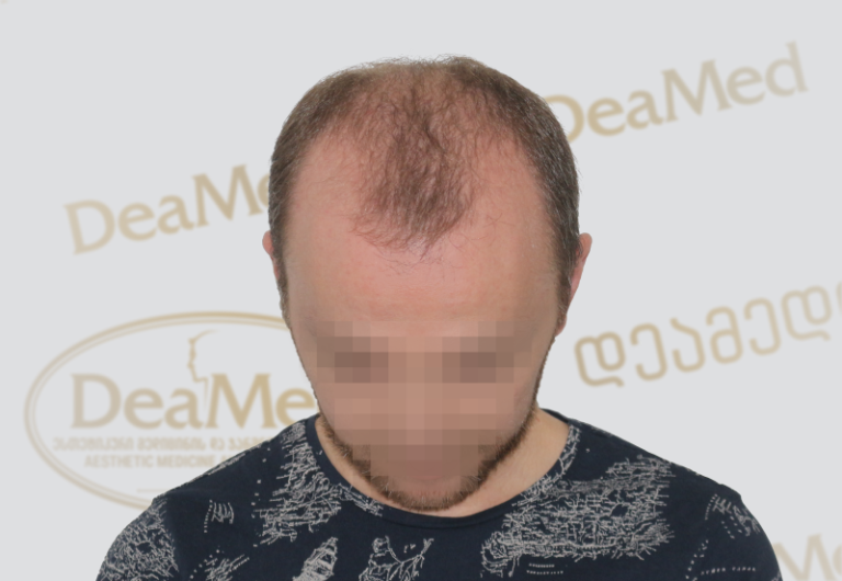 Deamed tmis gadanergva shedegebi