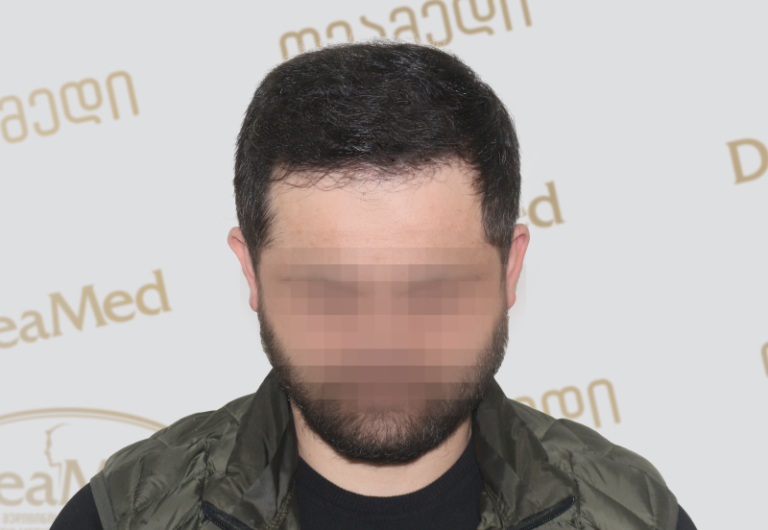 Deamed tmis gadanergva shedegebi