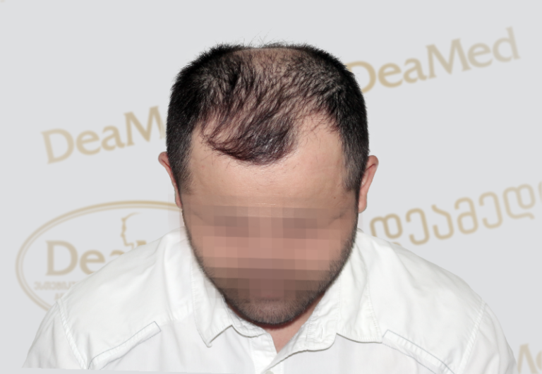 Deamed tmis gadanergva shedegebi