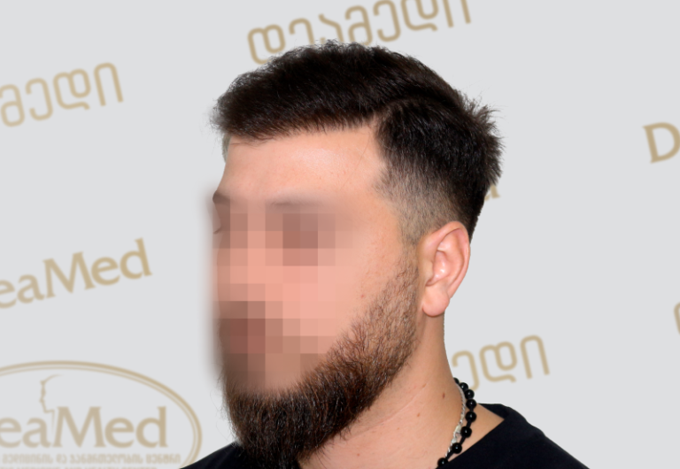 Deamed tmis gadanergva shedegebi