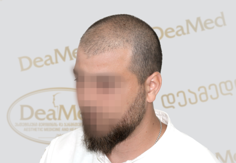 Deamed tmis gadanergva shedegebi