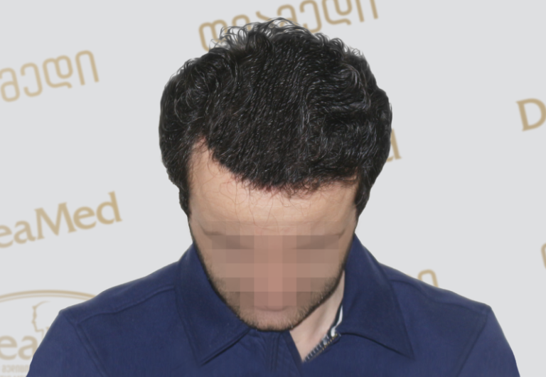 Deamed tmis gadanergva shedegebi