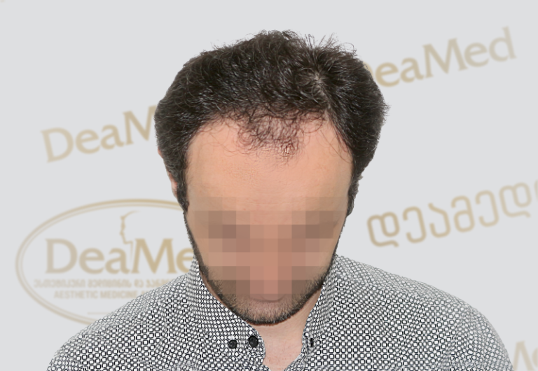 Deamed tmis gadanergva shedegebi