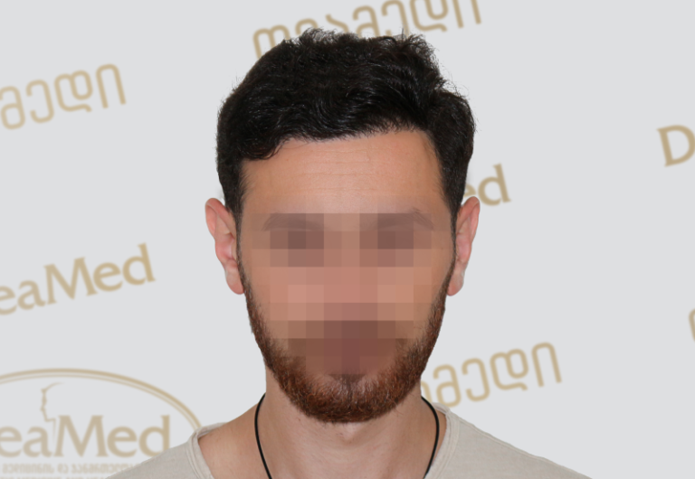 Deamed tmis gadanergva shedegebi