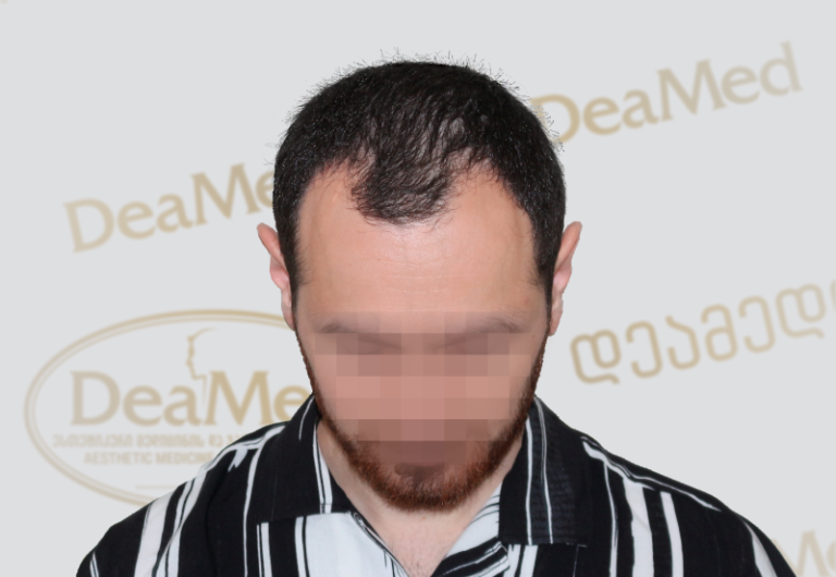 Deamed tmis gadanergva shedegebi