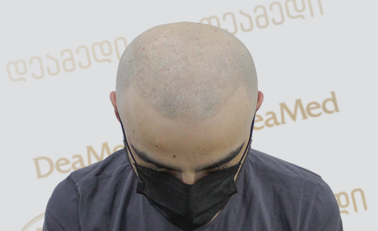 Deamed tmis gadanergva shedegebi