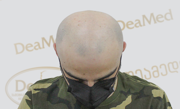 Deamed tmis gadanergva shedegebi