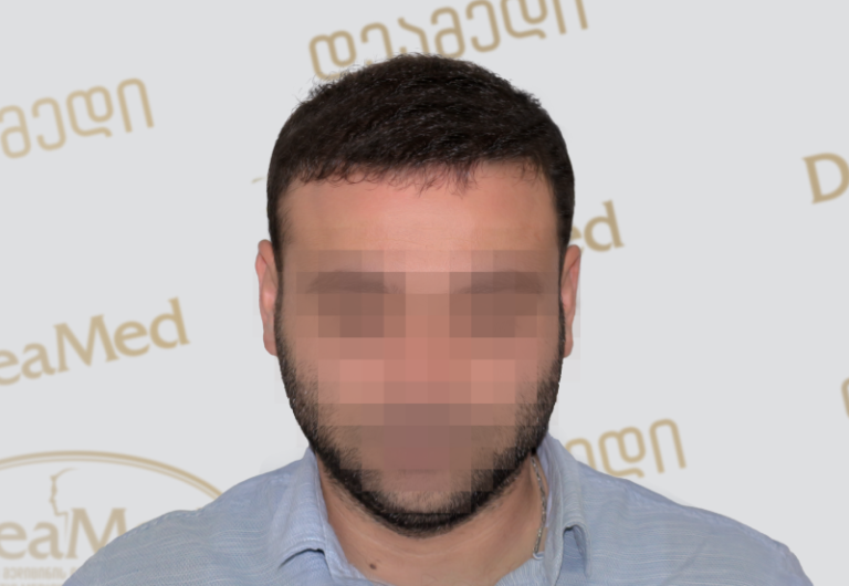 Deamed tmis gadanergva shedegebi