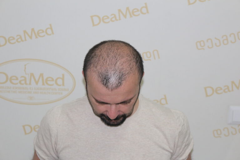 Deamed - hair transplantation results / თმის გადანერგვის შედეგები