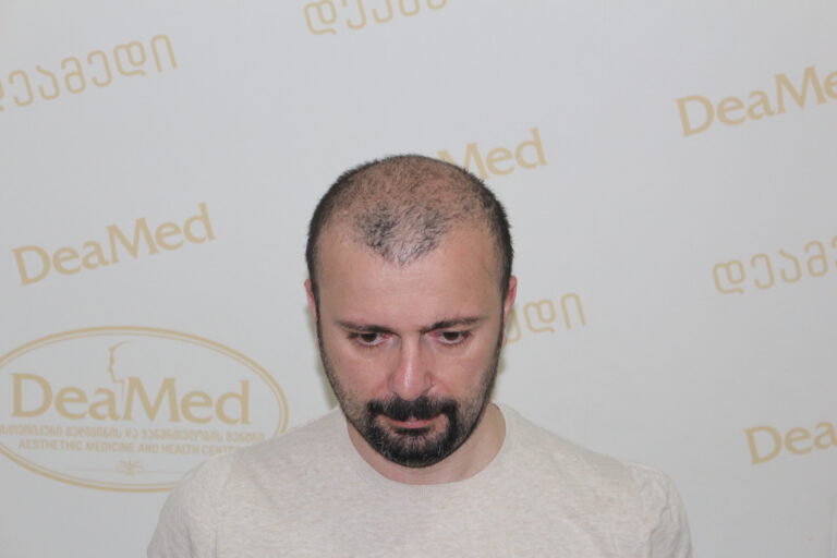 Deamed - hair transplantation results / თმის გადანერგვის შედეგები