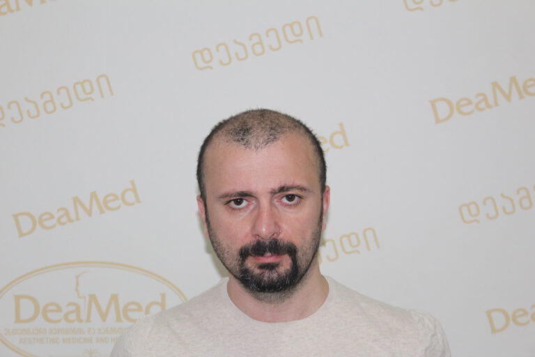 Deamed - hair transplantation results / თმის გადანერგვის შედეგები