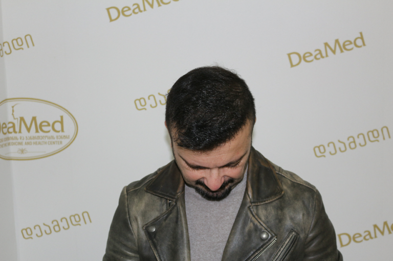 Deamed - hair transplantation results / თმის გადანერგვის შედეგები