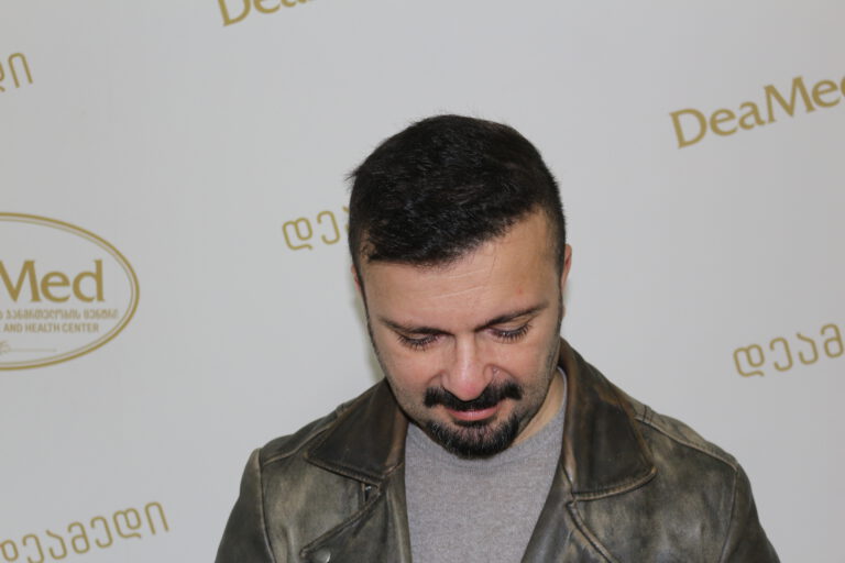 Deamed - hair transplantation results / თმის გადანერგვის შედეგები