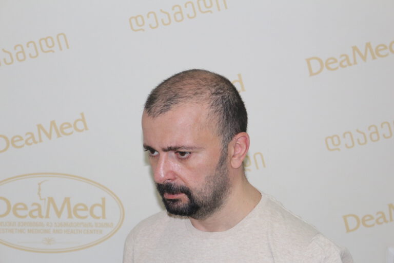 Deamed - hair transplantation results / თმის გადანერგვის შედეგები