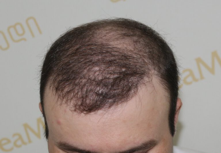 Deamed - hair transplantation results / თმის გადანერგვის შედეგები