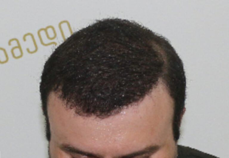 Deamed - hair transplantation results / თმის გადანერგვის შედეგები