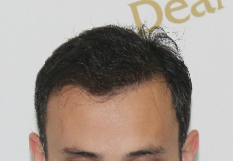 Deamed - hair transplantation results / თმის გადანერგვის შედეგები