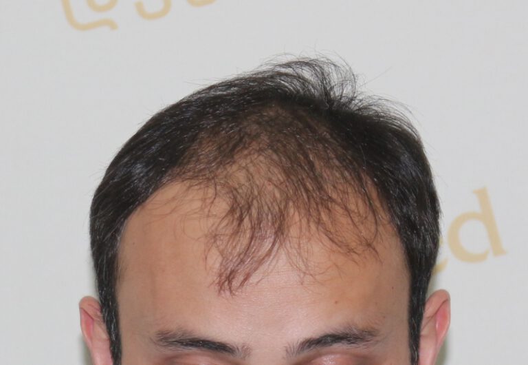 Deamed - hair transplantation results / თმის გადანერგვის შედეგები