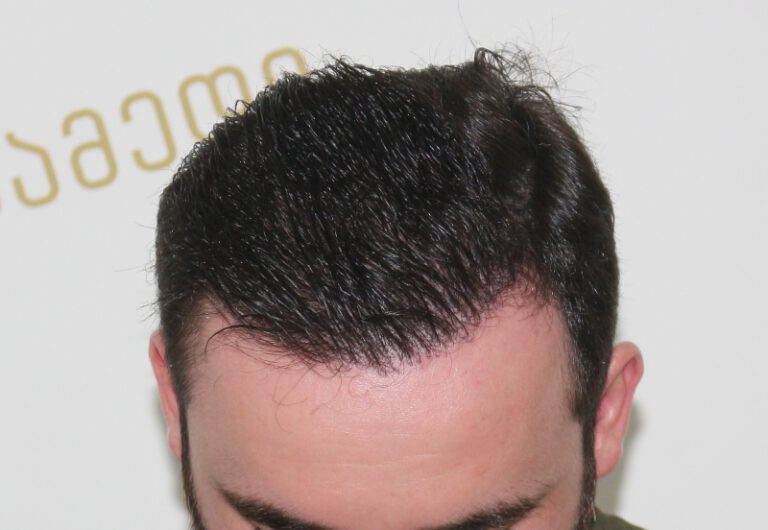 Deamed - hair transplantation results / თმის გადანერგვის შედეგები